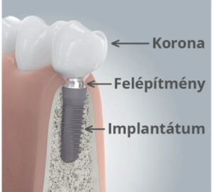 implant-felepites-abra.jpg