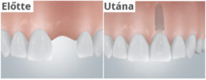 implant-elotte-utana-kep.jpg