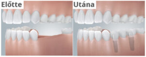 implantatum-elotte-utana-abra.jpg