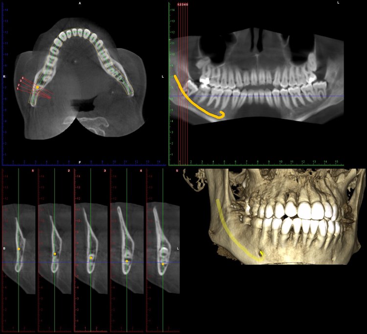 CBCT 3rd molar 1