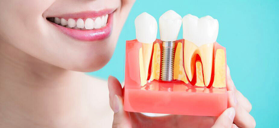 Mi a különbség az egyes fogászati implantátumok között? Miért ajánljuk a CAMLOG rendszert?